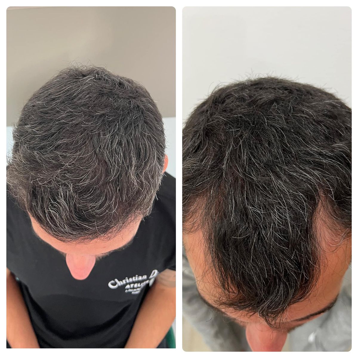 FOTO Romario Benzar, implant de păr și imagini cu Bianca, soția lui