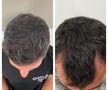 Fotbalistul pe care Becali a luat 2 milioane de euro și-a făcut implant de păr » Imagini spectaculoase: cum arată înainte și după intervenție