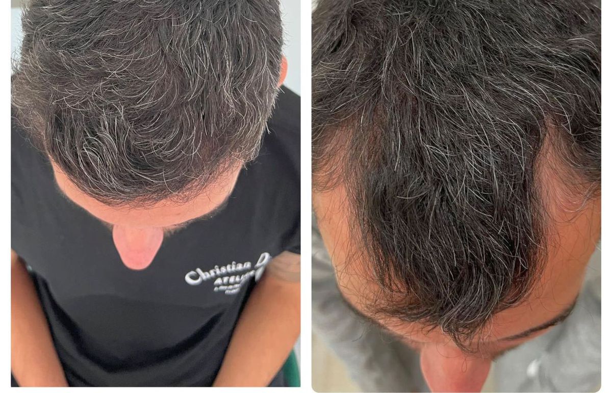 Fotbalistul pe care Becali a luat 2 milioane de euro și-a făcut implant de păr » Imagini spectaculoase: cum arată înainte și după intervenție