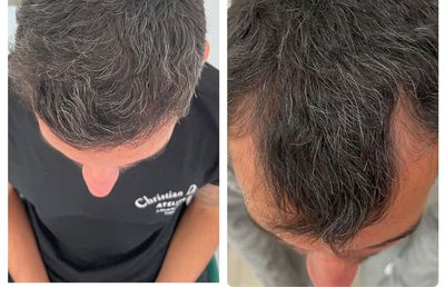 Fotbalistul pe care Becali a luat 2 milioane de euro și-a făcut implant de păr » Imagini spectaculoase: cum arată înainte și după intervenție