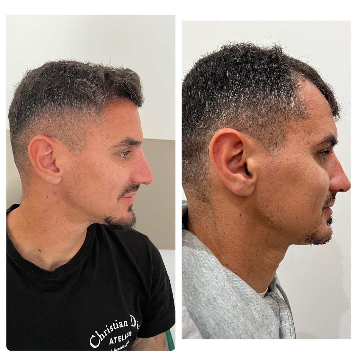 Fotbalistul pe care Becali a luat 2 milioane de euro și-a făcut implant de păr » Imagini spectaculoase: cum arată înainte și după intervenție