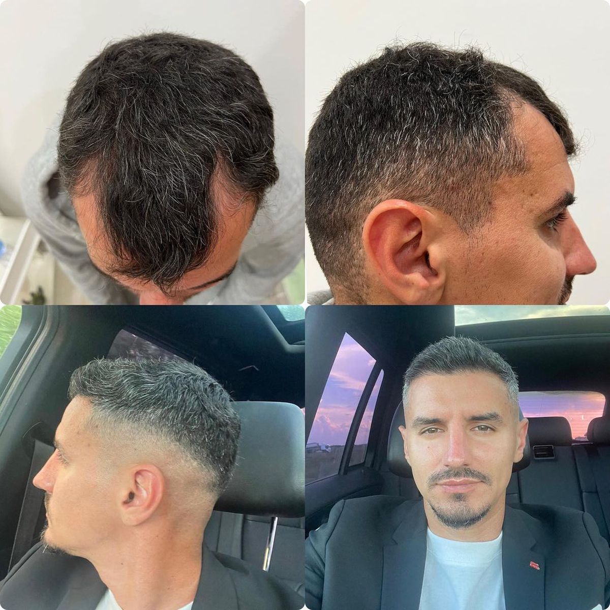 FOTO Romario Benzar, implant de păr și imagini cu Bianca, soția lui