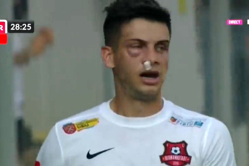 Mihai Butean (25 de ani), fundașul dreapta de la Hermannstadt, a fost lovit în față în prima repriza a meciului cu Chindia, la scorul de 1-1.