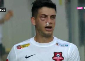 Atenție, imagini dure în Liga 1: hemoragie nazală și hematom pronunțat după o lovitură nesancționată de arbitri