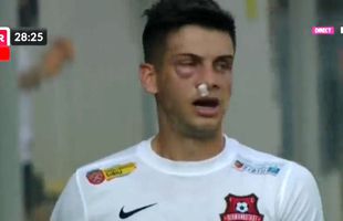 Atenție, imagini dure în Liga 1: hemoragie nazală și hematom pronunțat după o lovitură nesancționată de arbitri