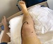 Piciorul lui Nițu, după una dintre intervențiile chirurgicale suferite
