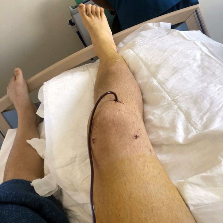 Piciorul lui Nițu, după una dintre intervențiile chirurgicale suferite