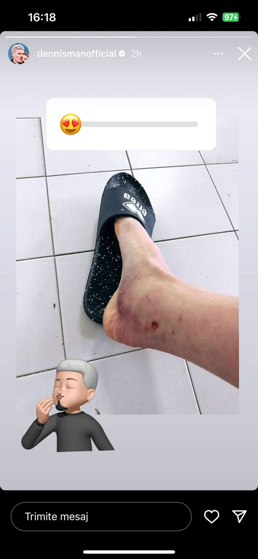 Imagine teribilă: cum arată piciorul lui Dennis Man după accidentarea din meciul cu Frosinone