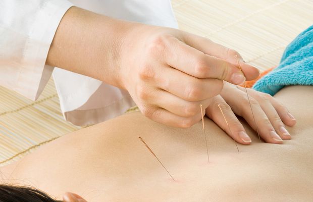 Descoperă puterea acupuncturii: Cum poate îmbunătăți sănătatea și starea de bine