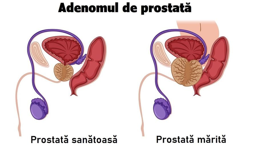 Adenomul de prostată – Ce este, care sunt simptomele și cum tratăm?