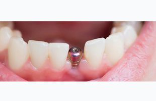 Cand avem nevoie de implant dentar?