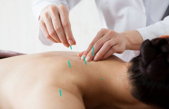 Tot ce trebuie să știm despre beneficiile pentru sănătate ale acupuncturii