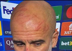 Pep Guardiola, însângerat după egalul cu Feyenoord! Cum a explicat rănile de pe figură