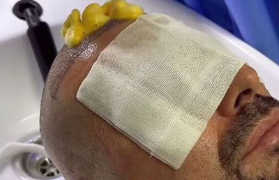 Adrian Mutu, la prima apriție publică după ce și-a făcut implant de păr