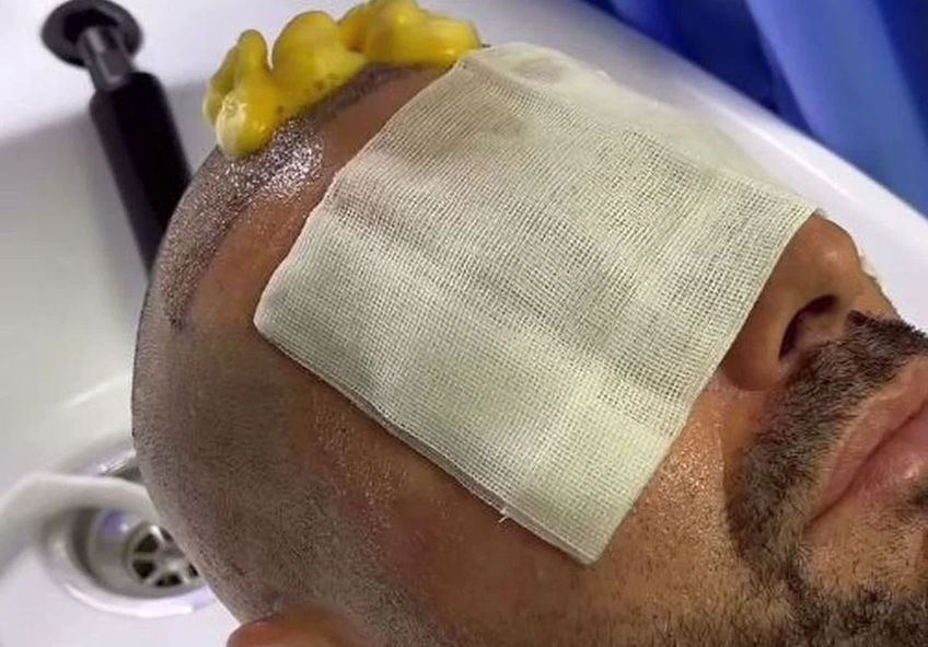 Adrian Mutu și-a făcut implant de păr