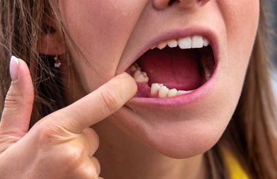 Impactul lipsei dinților asupra sănătății generale: Riscurile bacteriemiei