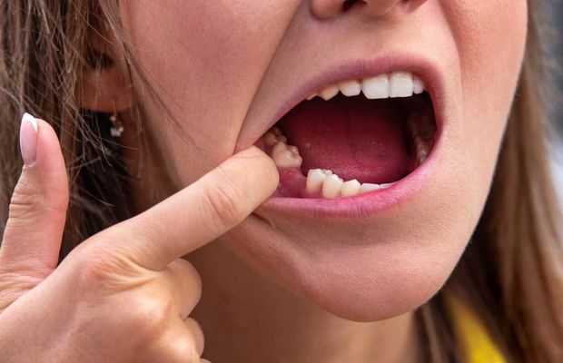 Impactul lipsei dinților asupra sănătății generale: Riscurile bacteriemiei