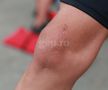 Panțîru e iarăși fotbalist, după doi ani și două luni de calvar! » Și-a lăsat fotografiat în detaliu genunchiul operat de 3 ori