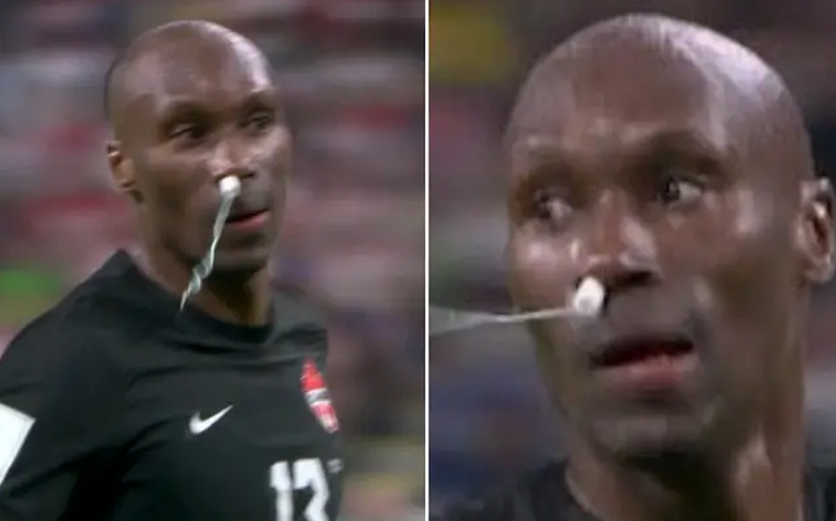 Moment nemaivăzut pe un teren de fotbal: a jucat cu un tampon în nas la Mondial!