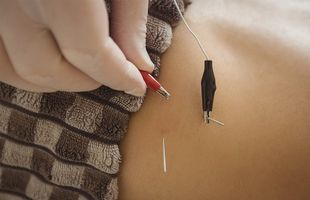 Cum poți să tratezi depresia cu ajutorul acupuncturii?