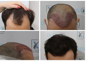 Află de aici de un implant de păr la clinică, Dr Felix Hair Implant te ajută în acest sens