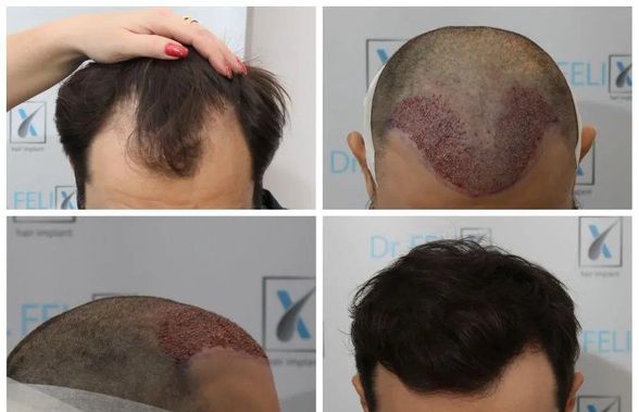 Află de aici de un implant de păr la clinică, Dr Felix Hair Implant te ajută în acest sens