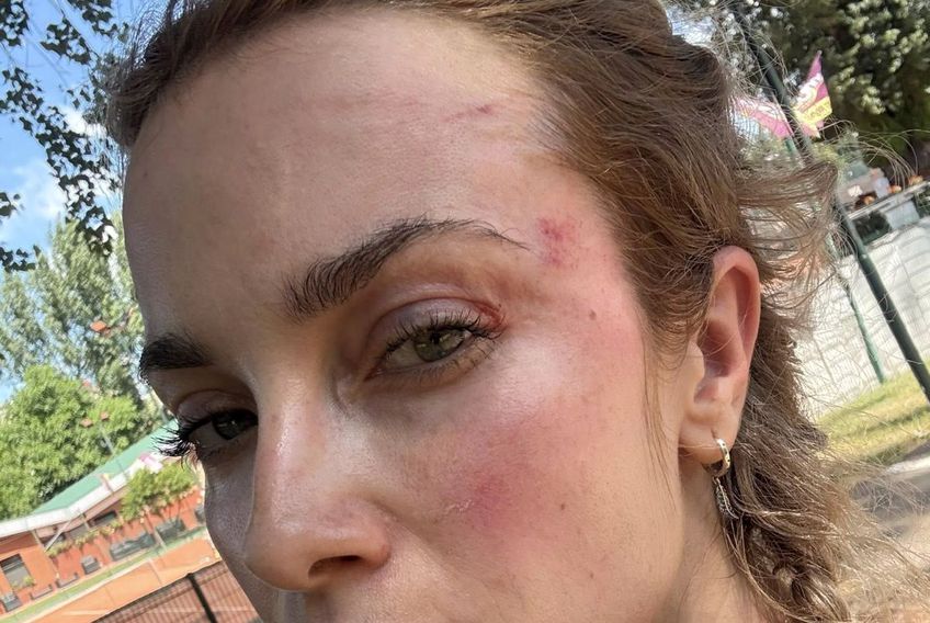 ATENȚIE, IMAGINI DURE Scene șocante la Cluj! O femeie a fost bătută de un fan U Cluj în parc: „A presupus că sunt ucraineancă și că nu am niciun drept aici”