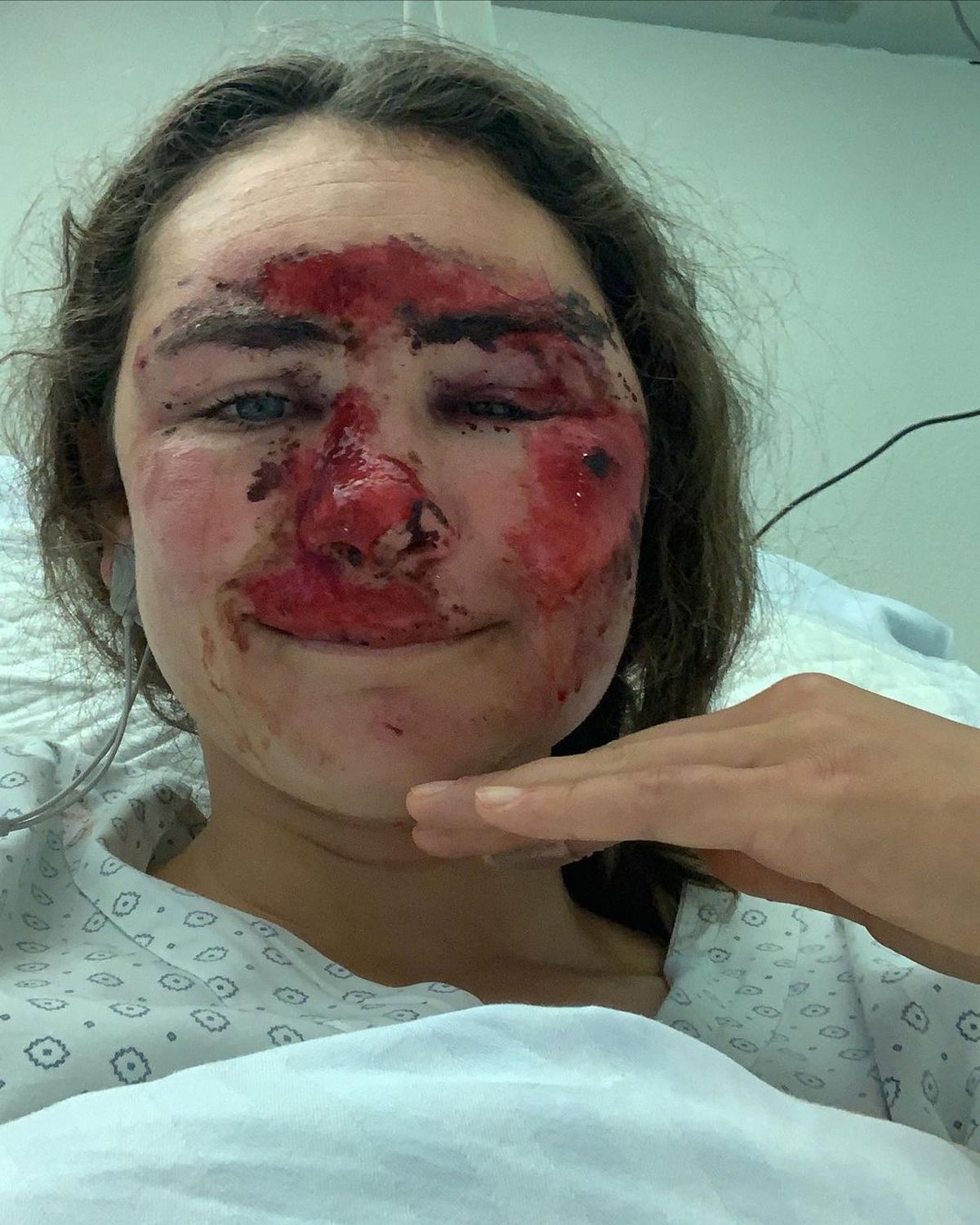 Vindecare în timp record » Cum arată acum Alice Merryweather, schioarea accidentată grav în urmă cu 3 săptămâni. Atenție, imagini dure!