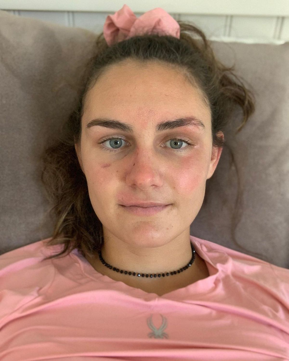 Vindecare în timp record » Cum arată acum Alice Merryweather, schioarea accidentată grav în urmă cu 3 săptămâni. Atenție, imagini dure!