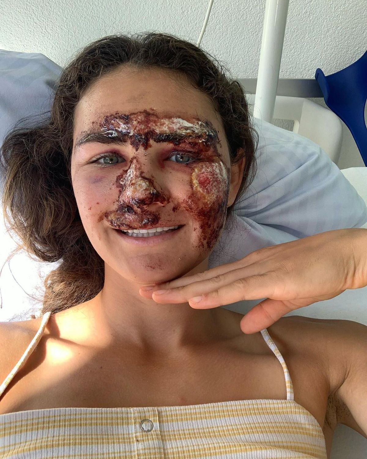 Vindecare în timp record » Cum arată acum Alice Merryweather, schioarea accidentată grav în urmă cu 3 săptămâni. Atenție, imagini dure!