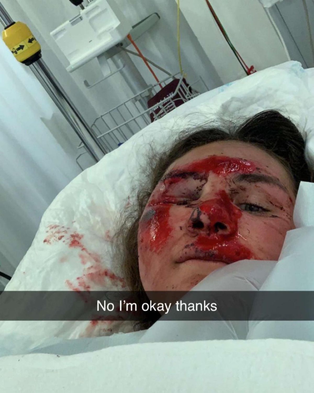 Vindecare în timp record » Cum arată acum Alice Merryweather, schioarea accidentată grav în urmă cu 3 săptămâni. Atenție, imagini dure!