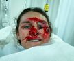 Vindecare în timp record » Cum arată acum Alice Merryweather, schioarea accidentată grav în urmă cu 3 săptămâni. Atenție, imagini dure!