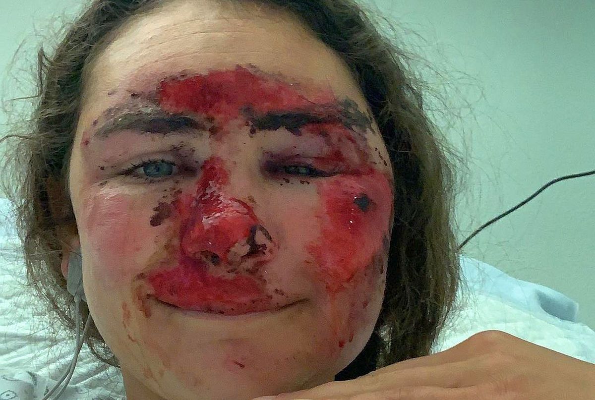 Vindecare în timp record » Cum arată acum Alice Merryweather, schioarea accidentată grav în urmă cu 3 săptămâni. Atenție, imagini dure!