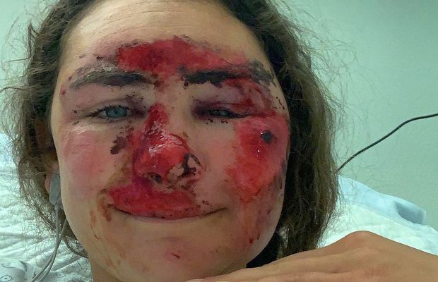 Vindecare în timp record » Cum arată acum Alice Merryweather, schioarea accidentată grav în urmă cu 3 săptămâni. Atenție, imagini dure!