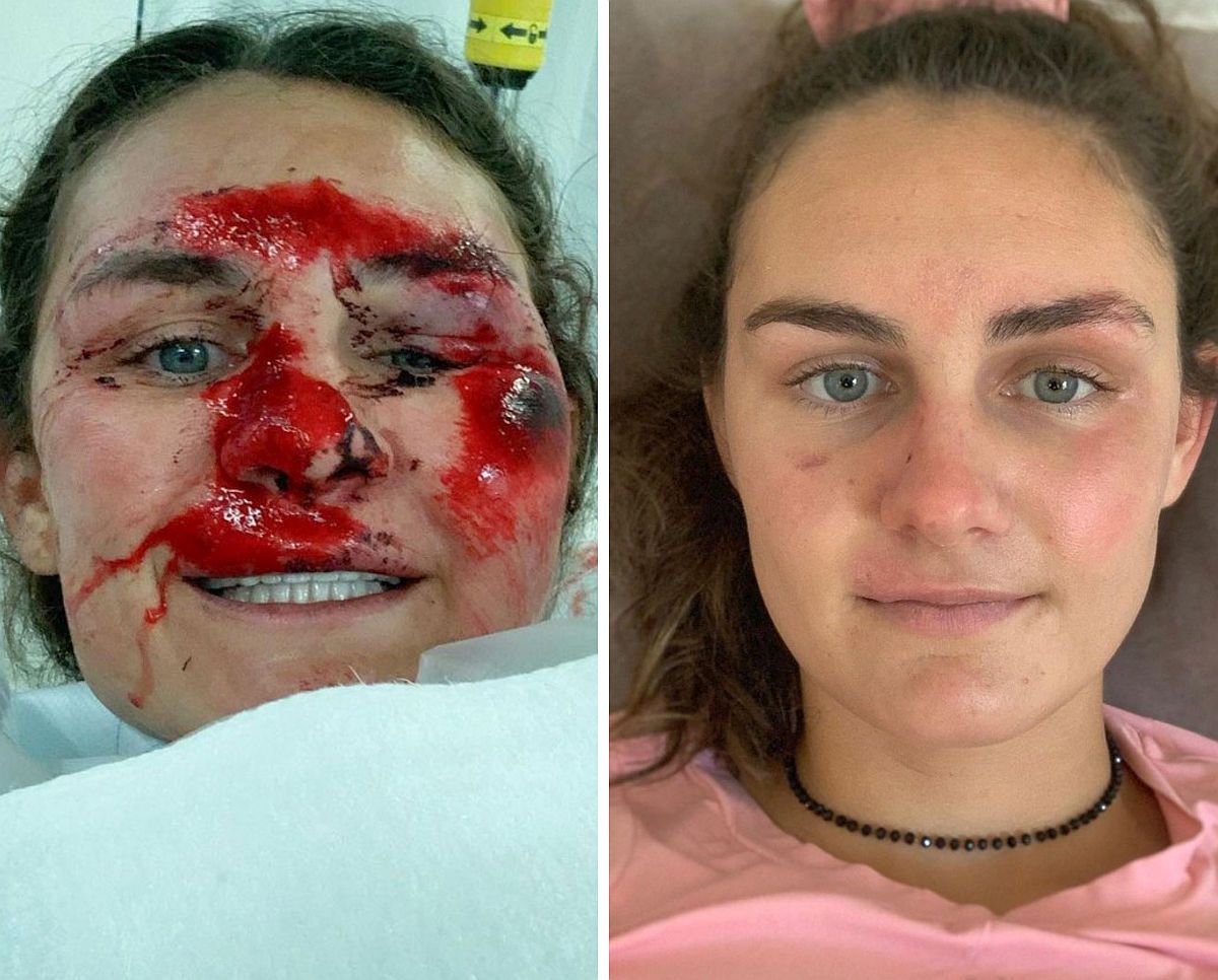 Vindecare în timp record » Cum arată acum Alice Merryweather, schioarea accidentată grav în urmă cu 3 săptămâni. Atenție, imagini dure!