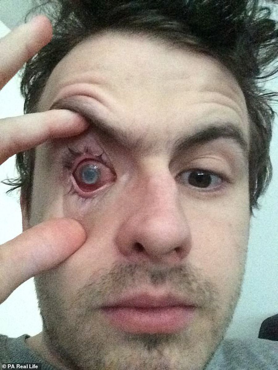 Un fotbalist și-a pierdut vederea la un ochi! Ce s-a întâmplat după ce a intrat în duș cu lentilele de contact
